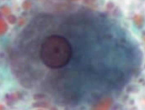 <p>Species and Stage: E. histolytica, Trophozoite<br>Locomotion: Pseudopodia</p>