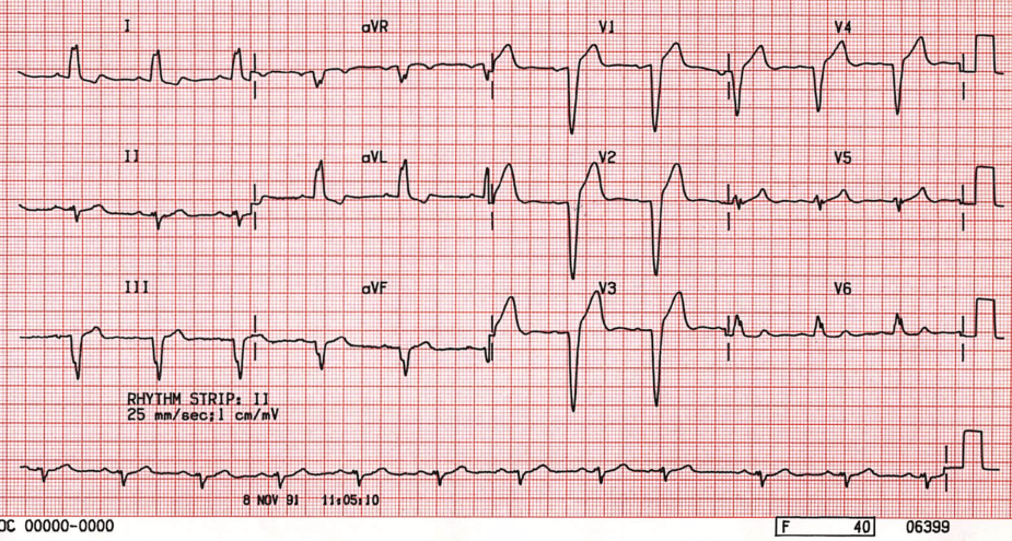 <p>Delay in depolarization of LV; entire sequence of ventricular activation is altered, affecting both the initial septal and subsequent ventricular forces. Does NOT occur in a healthy heart </p><p>-Broad, notched, or slurred R waves in leads I, aVL, V5/V6, and dominant S wave in lead 1</p>