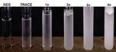 <p>Protein is precipitated out with Sulfosalicylic acid (SSA), then turbidity of the precipitated is measured</p><p>Semi-Quantitative test</p><p>other: Trichloroacetic acid or Benzethonium chloride</p>