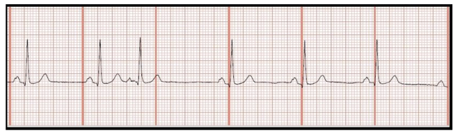 <p>Identify the above waveform:</p><p>a. Atrial flutter</p><p>b. sinus bradycardia</p><p>c. PVC (premature vent contraction)</p><p>d. PAC (premature atrial contraction)</p>