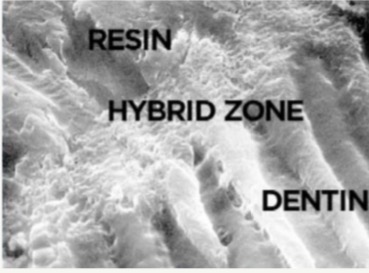 <p>Micro mechanical attachment between resin and demineralised, primed layer of intertubular dentin</p><p>Achieved by etching to remove smear layer and produce demineralisation of 3-6um</p>