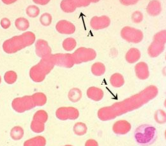 <p>appears as a "stack of coins"</p><p>clumping induced by circulating paraproteins</p><p>Condition associated: paraproteinemia (plastic cell myeloma) & Multiple myeloma</p>