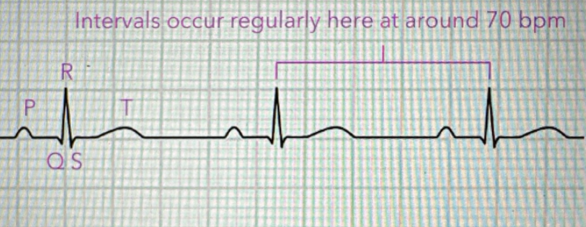 <p>Regular rhythm, 60–100 bpm, normal P before every QRS</p><p></p>