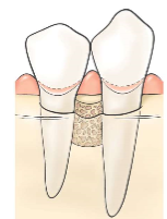 <p>Intrabony defect with 3 bony walls.</p><p>(Explanation: Circumferential defects, surrounded by three walls, have the highest regenerative potential due to greater bone support, ideal for grafting and GTR.)</p>