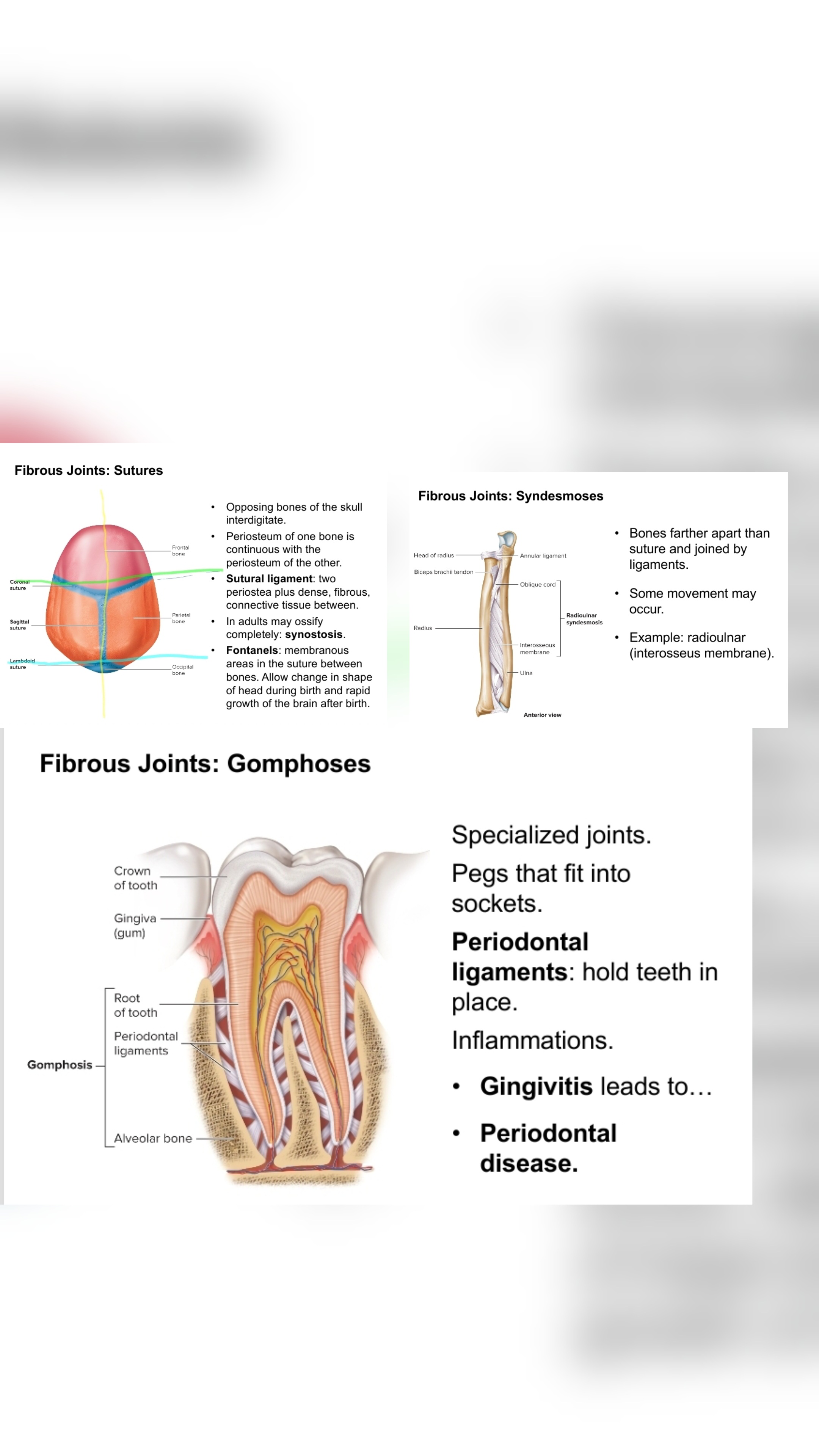 <p>Exhibit little to no movementand have no joint cavity. They are united by fibrous connective tissue. </p><p></p><p>Commen examples include <span style="color: green;">SUTURES</span> → skull bones joined together, <span style="color: green;">SYNDESMOSES</span> → bones connected by a ligament or interosseous membrane (radius-ulna, tibia-fibula), and <span style="color: green;">GOMPHOSIS</span> → which are a periodontal ligament that hold your teeth in place.</p>