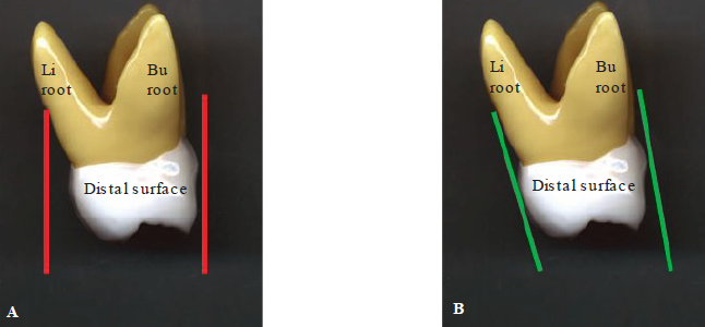 <p><span style="color: rgb(255, 0, 0);"><strong>A: Incorrect </strong></span></p><ul><li><p>Red lines — incorrect alignment to lingual and facial surfaces of maxillary molar</p></li></ul><p></p><p><span style="color: green;"><strong>B: Correct</strong></span></p><ul><li><p>Green lines — Correct alignment to lingual and facial surfaces of maxillary molar</p></li></ul><p></p>