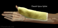 <p>Difficult to detect on plain film even with a Scaphoid View (inform pts of this) → if Snuff Box tenderness → Thumb Spica & Ortho follow-up (best appreciated with MRI)</p><p>**Important not to miss this fracture due to the limited blood supply to this area from the Radial Artery; if left untreated → avascular necrosis</p>