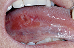 <p>A clinical term used to describe an oral lesion that appears as a smooth red patch or granular, red and velvety patch. Less common than leukoplakia.</p>