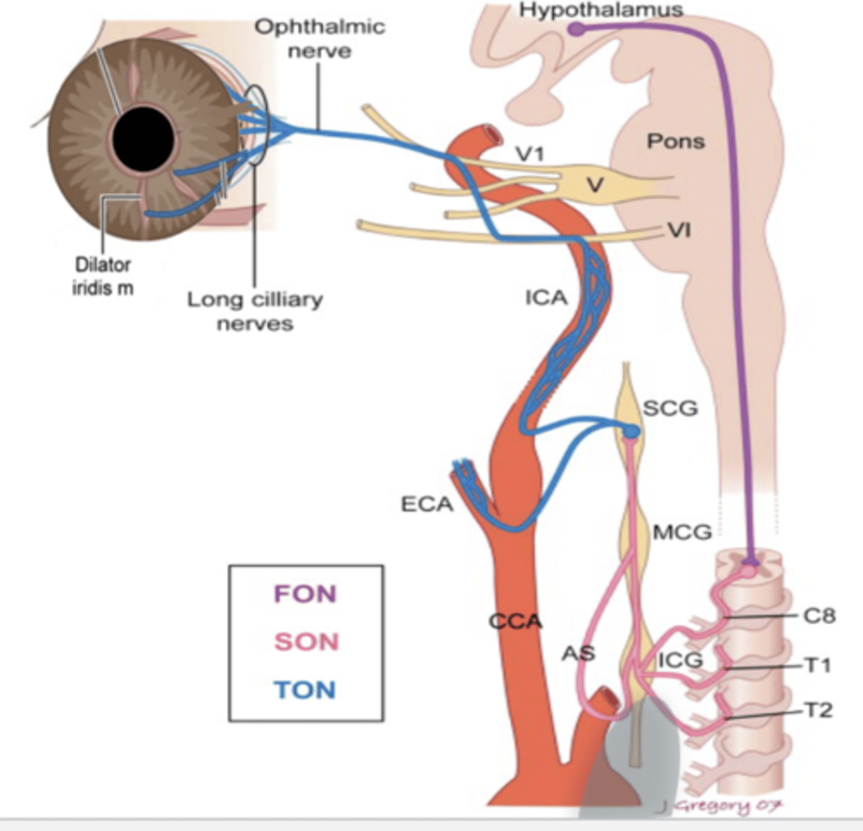 <p>1. hypothalamus senses fact that there is less light available </p><p>2. travels down pons, brainstem to first order neuron to C8, T1, T2 (ciliospinal center of Budge Waller, first extension cord)</p><p>3. synapses with second order neuron then travels up to inferior cervical ganglion, medial cervical ganglion, and superior cervical ganglion. </p><p>(basically goes down the neck/spine, then goes back upwards)</p><p>- important area bc adjacent to heart is lung </p><p>- if there is tumor of the lung it is along the apex of the second order neuron</p><p>- interferes with pupil dilation</p><p>- HORNER's </p><p>4. synapses with third order neuron, goes up internal carotid artery (could also horner's if there is lesion along ICA, now considered postganglionic)</p><p>5. goes to V1, long ciliary nerve, iris dilator, cause mydriasis </p><p>6. norepi is only released at the end terminal to bind onto the A1 receptors at the iris dilator for mydriasis</p>