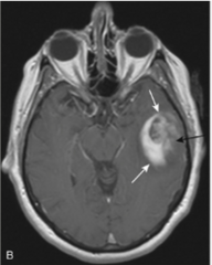 <p>common intraaxial (w/in brain parenchyma) mass in an adult</p>