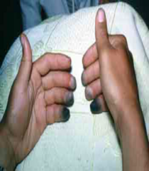 <p>- Freezing with death of skin, hemorrhagic blisters</p><p>- Skin necrosis</p><p>- Blue-gray discoloration</p>