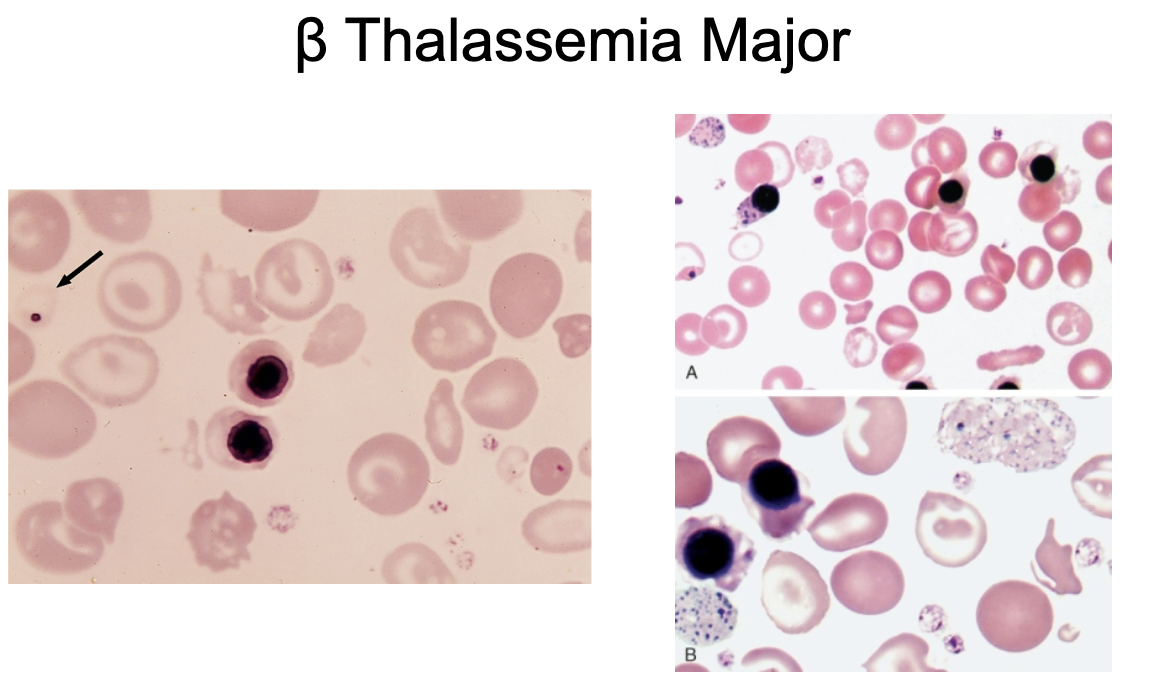 <p>What is on a peripheral blood smear for <strong>B thalassemia major? </strong></p>
