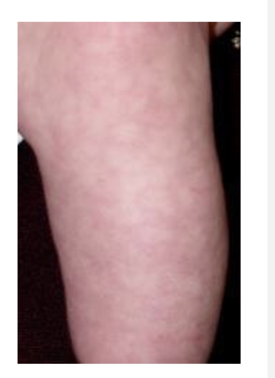 <p>Cutis Marmorta (Mottling)</p>