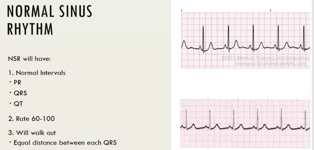 <p>normal sinus rhythm</p>
