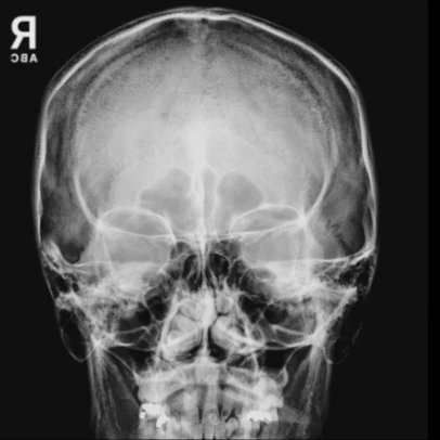 <p>PA Axial Caldwell’s view demonstrates:</p>