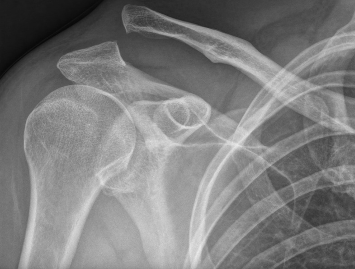 <p>What grade is the acromioclavicular separation?</p>