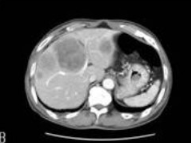 <p>Match image to phase:</p><p>occurs not to long after injection (approx. 60 – 90 secs)it is defined by a density difference between the abdomen aorta and ivc of 10 and 30 HU. The contrast is being pushed from the capillaries into the veins therefore decreasing the density between the aorta and ivc.</p>