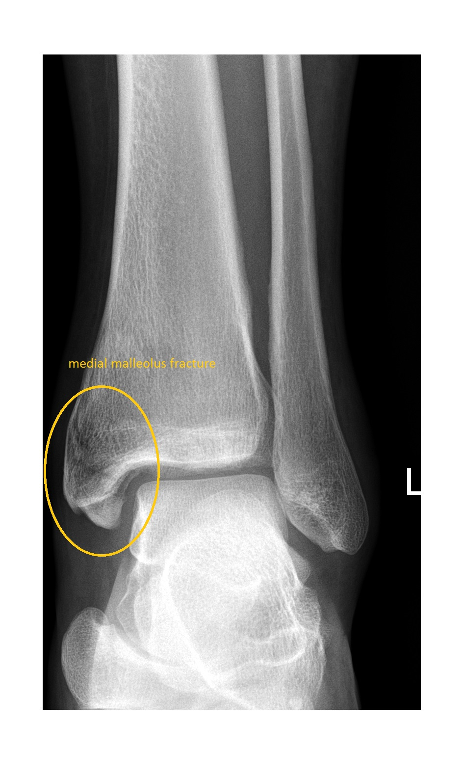 <p>claw (hook), inside of leg, tibia, right under medial condyle, bottom of tibia </p>
