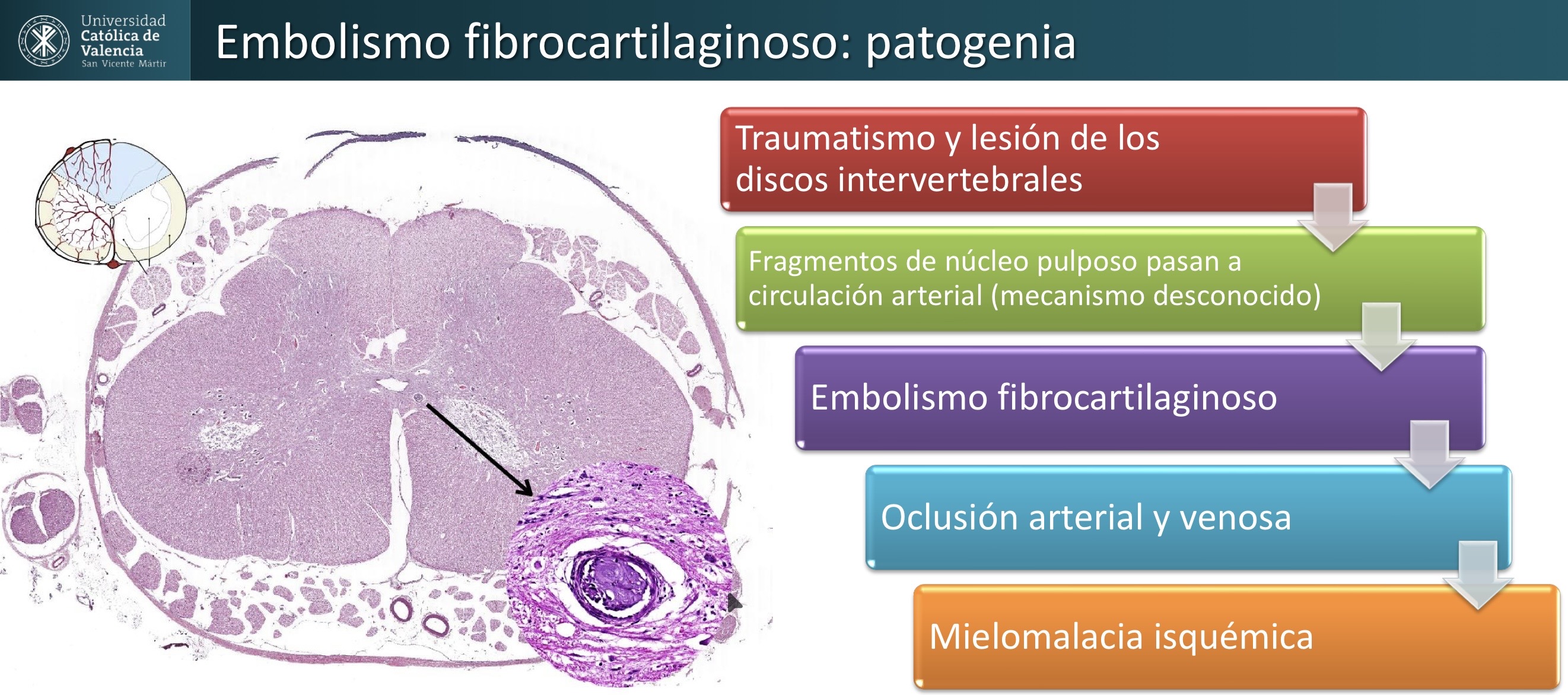<p>NEURO: Embolismo fibrocartilaginoso</p>