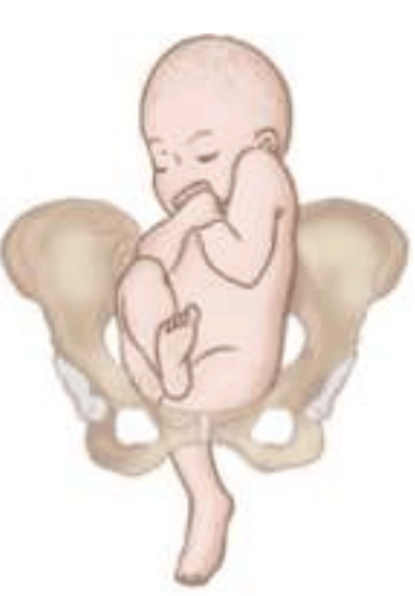 <p>1 or both hips not completely flexed, presenting part maybe buttocks or one or both feet</p>