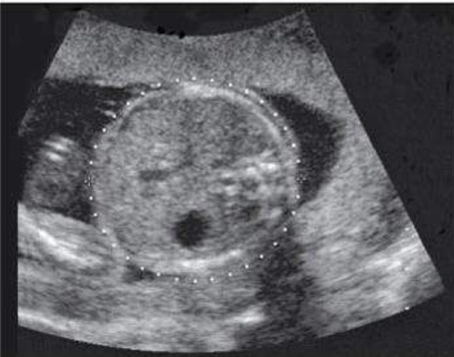 <p>Site of production of red blood cells; proportionately much greater in size in fetus than in adult; demonstrates as a homogeneous, mid-gray structure on right upper quadrant</p>