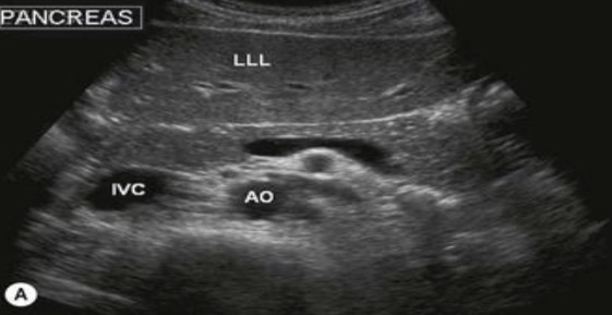 <p>Dumbbell or sausage shaped </p><p>Non-capsulated </p><p>Lies transversely in the retroperitoneal cavity</p><p>Extends from C-loop of duodenal to the splenic hilum*</p>