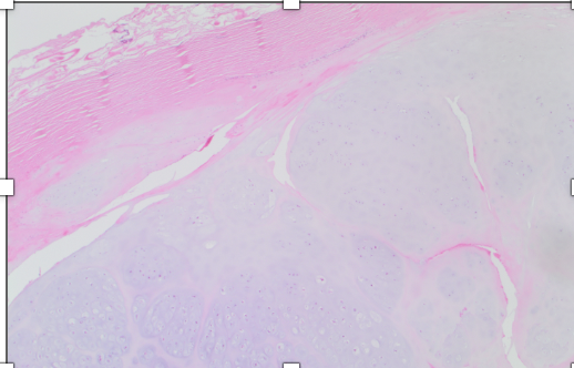 <p>Lésion jeune homme métaphyse fémur, superficiel</p><p>diagnostic</p><p>définition</p><p>age</p><p>topographie</p><p>anatomie</p><p>histologie</p><p>ihc et moléculaire</p>