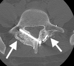 <p>generally, observation, managed by PCP</p><p>surgical if fracture has failed observation, activity modification</p>