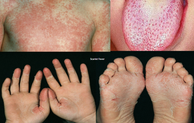 <p>scarlet fever cause</p>
