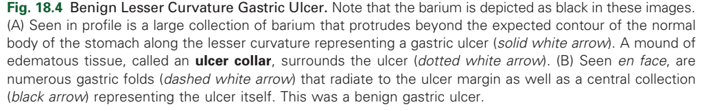 <p>Benign Lesser Curvature Gastric Ulcer.</p>