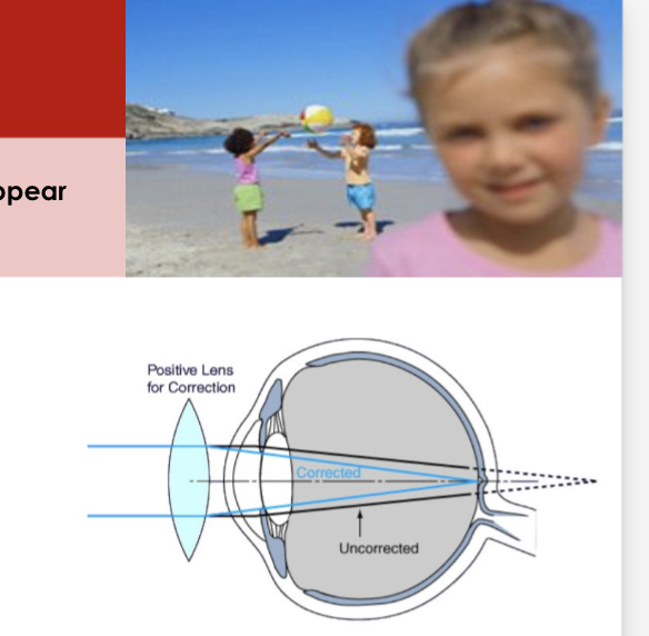 <ul><li><p>Causes- The eyeball is too short or the cornea is too flat → image is focused behind the retina</p></li><li><p>Symptoms- Nearby objects look blurry</p></li><li><p>Convex lens shortens the focal length OR laser surgery to change the shape of the cornea or lens</p></li></ul><p></p>