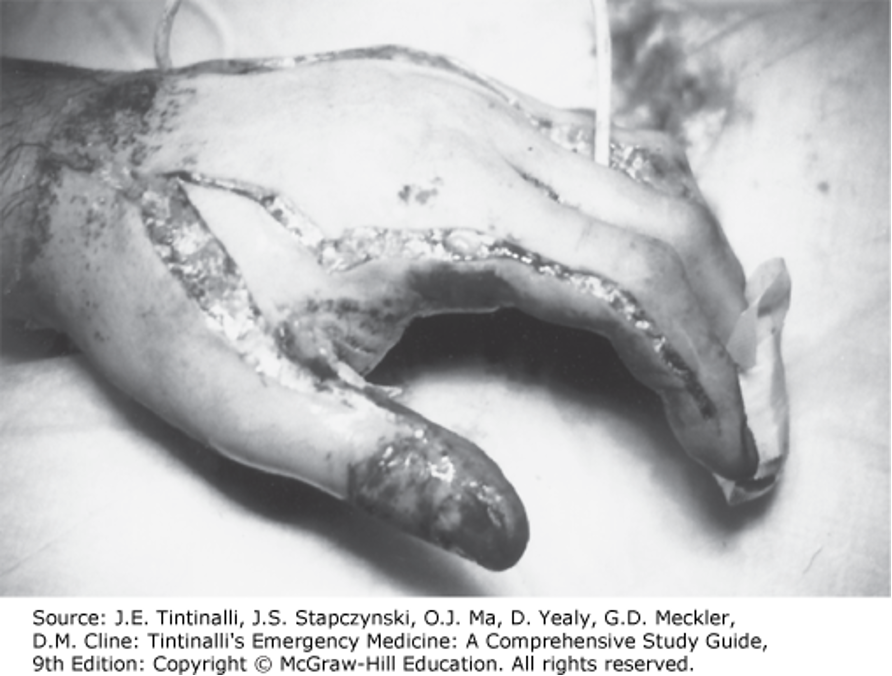 <ul><li><p>Indicated in circumferential deep burns</p><ul><li><p>In the limbs → can cause compromised of distal circulation, especially after initial resuscitation</p></li><li><p>Must monitor distal vascular status</p></li></ul></li><li><p>If vascular compromise evident → eshcarotomy indicated</p><ul><li><p>Eschar incised with scalpel at the level of the fat → done on the mid-lateral portion of the limb, avoiding the fascia </p></li><li><p>May extend to hand and fingers </p></li><li><p>Can provoke substantial soft tissue bleeding </p></li></ul></li><li><p>If circumferential burns to chest and neck → may restrict ventilation </p><ul><li><p>Incision made along anterior axillary line from level of second rib to level of 12th rib </p></li><li><p>The two incisions should be joined transversely so the chest wall can expand </p></li></ul></li></ul><p></p>