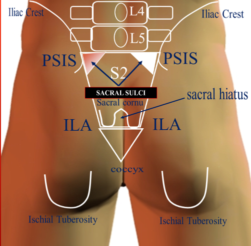 <ul><li><p>sacral sulcus</p></li><li><p>sacral foramina</p></li><li><p>inferior lateral angle (ILA)</p></li><li><p>ischial tuberosity</p></li></ul><p></p>