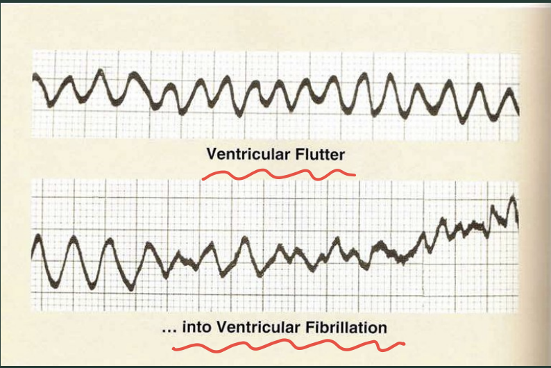 <p>What’s ventricular flutter deterioration?</p>