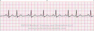 <p>Sinus tachycardia with premature junctional complexes </p>