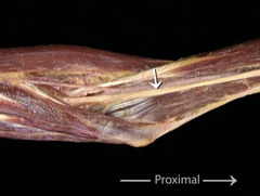 <p>In this anterior view of the right arm and elbow, identify the nerve indicated by the arrows.</p>