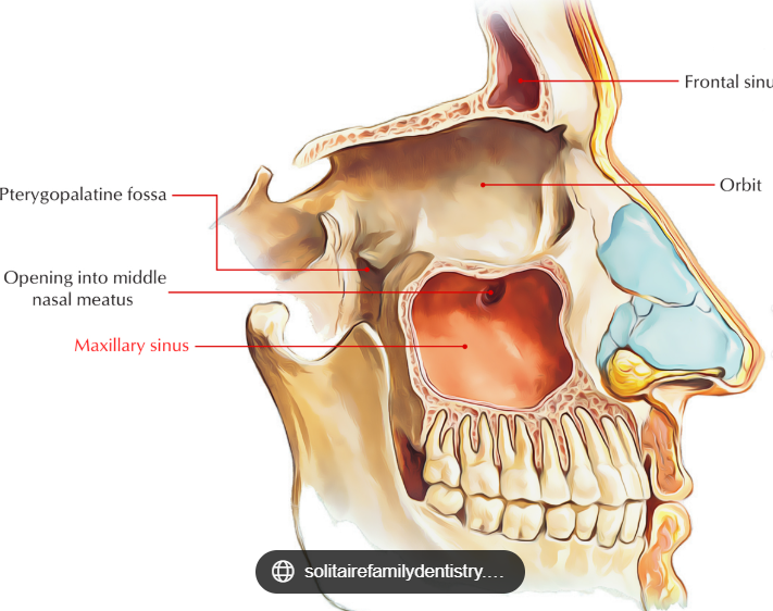 <ol><li><p><span style="background-color: transparent;"> local invasion</span></p></li></ol><p>Reasoning:</p><p><span>The maxillary sinus has:</span></p><ul><li><p><span><strong>Thin bony walls</strong></span></p></li><li><p><span><strong>Very rich local connections</strong> to the orbit, nasal cavity, palate, pterygopalatine fossa, and infratemporal fossa</span></p></li><li><p><span><strong>Relatively sparse lymphatic drainage</strong> compared to other head & neck sites</span></p></li></ul><p><span>Because of this anatomy, the tumor tends to <strong>erode bone early</strong> and extend directly into nearby structures.</span></p>
