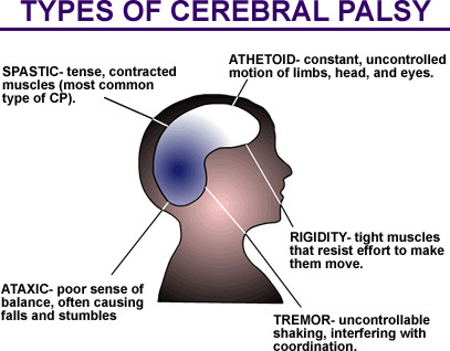 <p>This disease is a neuromuscular disability in which the voluntary muscles are poorly controlled and spastic because of a brain damage.</p>