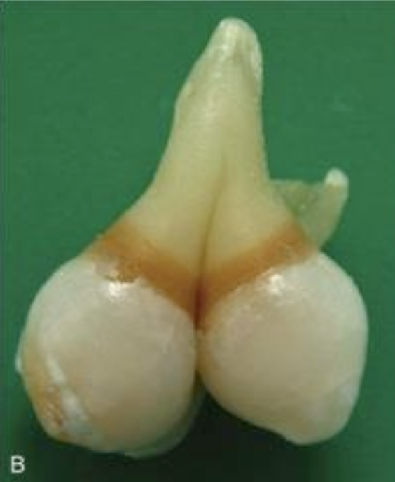 <p>Which of the following tooth abnormalities is shown in the figure?</p><p>A. Gemination </p><p>B. Fusion </p><p>C. Dens Invaginatus </p><p>D. Taurodont tooth </p>