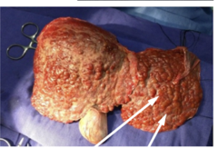 <p>patient presents with splenomegaly (due to portal hypertension) and ascites. Liver has "hobnail" appearance. Patient is a long time factory worker and has hep B. what is the diagnosis?</p>