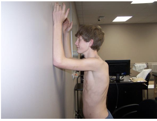 <p>The patient places the forearms on a wall in neutral with elbows flexed and arm in the plane of the scapula. The patient is then instructed to slide the forearms up the wall and lower with control.</p><p>Note: SA activation during wall slide is not much different than a push up plus exercise. However, this exercise allows for this activation overhead, where pts with shoulder impingement have been shown to have altered scapular mechanics and decreased SA activity. </p>