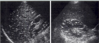 <p>the most common hepatic neoplasm in patients with AIDS, reported in 34% of cases in an autopsy series. Hepatic KS is typically asymptomatic and rarely diagnosed in life</p><p>“starry sky” pattern</p>