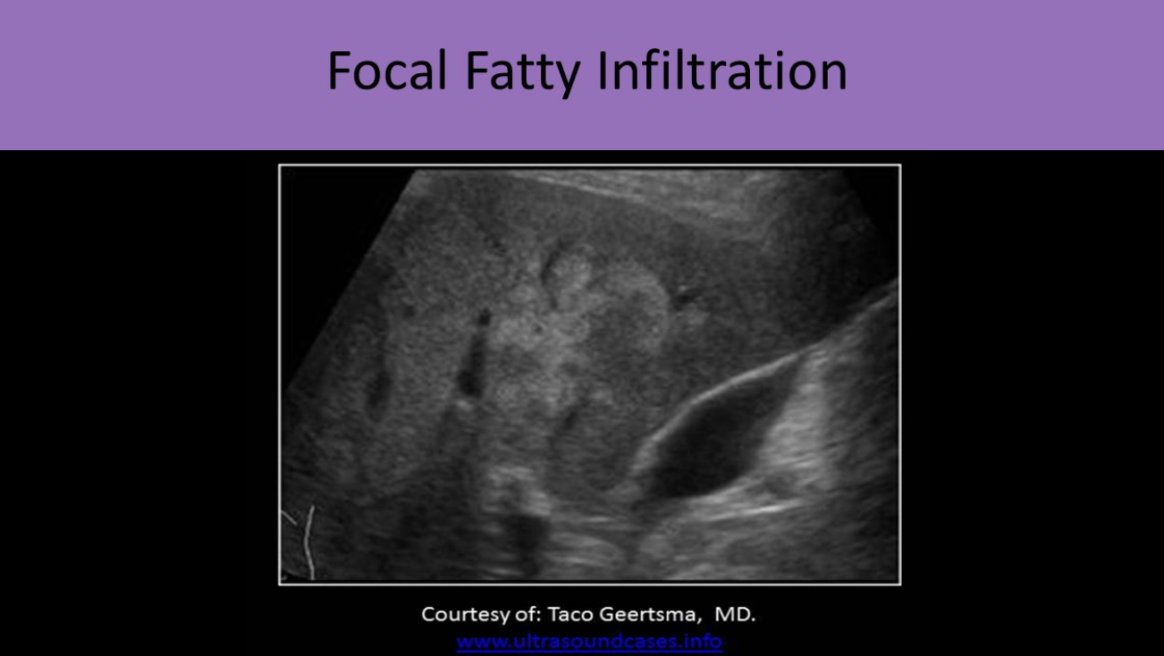 <ul><li><p>focal area of increased echogenicity</p></li><li><p>irregular borders</p></li><li><p>adjacent to portal structures</p></li><li><p>looks like hemangiomas</p></li><li><p>does NOT displace surrounding structures</p></li></ul><p></p>