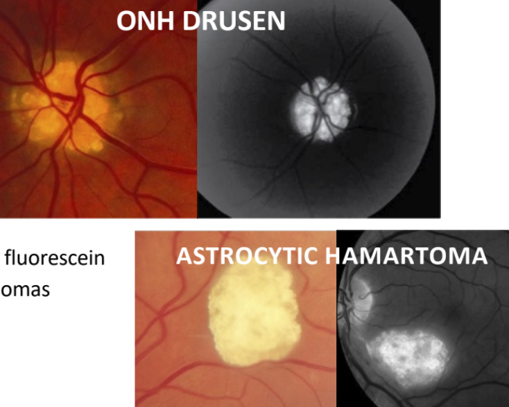 <ul><li><p>Fluorescence in the absence of fluorescein dye</p></li><li><p>Commonly caused by ONH drusen, astrocytic hamartomas</p></li></ul><p></p>