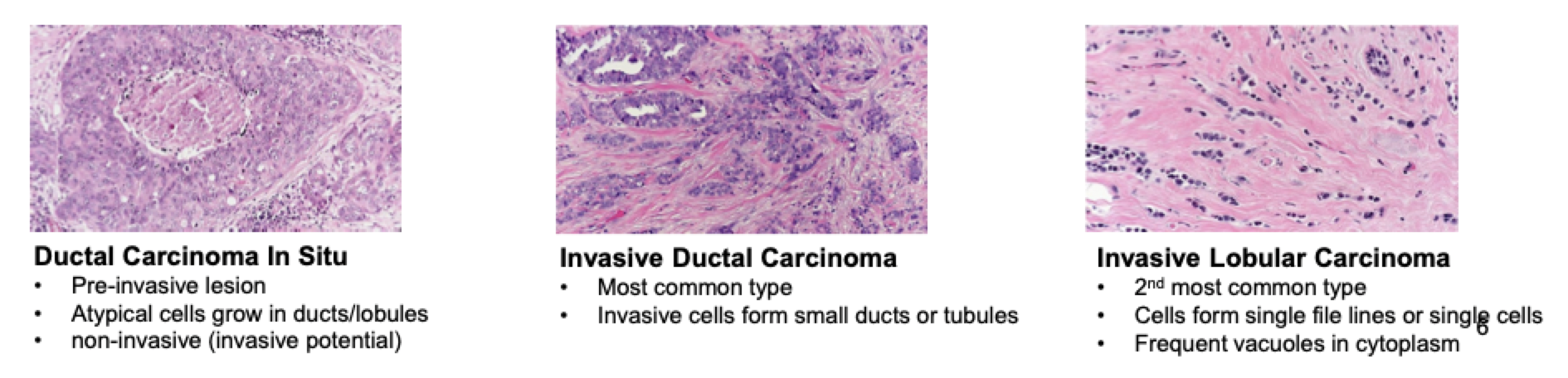 <ul><li><p><strong>Ductal carcinoma in situ (DCIS):</strong></p><ul><li><p>Pre-invasive lesion</p></li><li><p>Atypical cells in ducts/lobules</p></li><li><p>Non-invasive but has invasive potential</p></li></ul></li><li><p><strong>Invasive ductal carcinoma:</strong></p><ul><li><p><strong>Most common type</strong></p></li><li><p>Cells form <strong>small ducts or tubules</strong></p></li></ul></li><li><p><strong>Invasive lobular carcinoma:</strong></p><ul><li><p><strong>2nd most common type</strong></p></li><li><p>Cells form <strong>single-file lines or single cells</strong></p></li><li><p><strong>Frequent cytoplasmic vacuoles</strong></p></li></ul></li></ul><p></p>