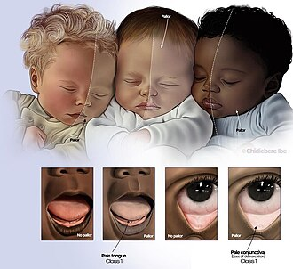 <p>An abnormal paleness of the skin or mucous membranes, usually caused by reduced blood flow or low hemoglobin (anemia).</p>