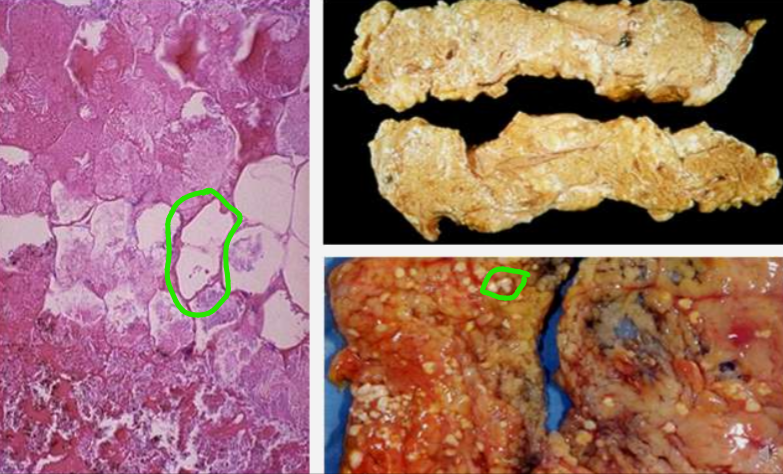 <ul><li><p>kreminė, balta masė</p></li><li><p>balkšvi žydinukai</p></li><li><p>riebalų ląst. branduolio nematyti</p></li></ul><p></p>