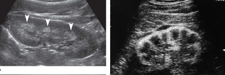 <p>deposit of calcium in kidney </p><ul><li><p>both kidneys affected</p></li><li><p>focal increases i echogenicity in renal pyramids </p></li><li><p>can be seen in medulla and cortex</p></li></ul><p></p>