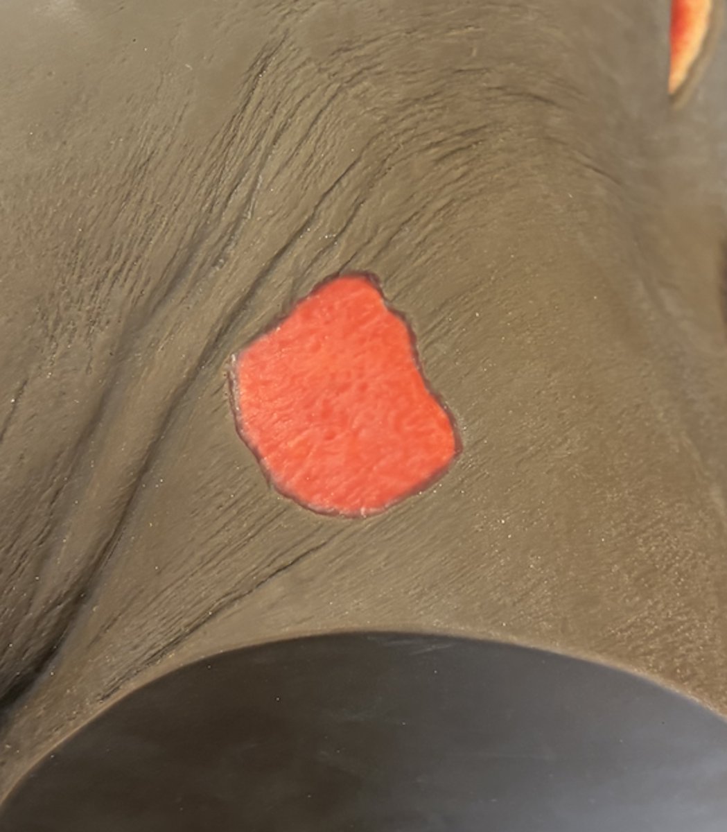 <p>what wound is this and how do you care for it?</p>