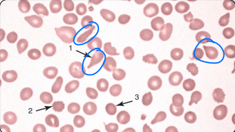<p>dacrocyte (teardrop cell)</p>